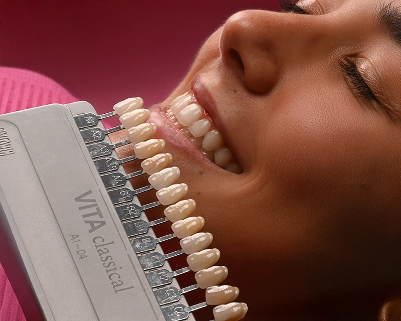 Faccette Dentali a Sassari e a Nuoro